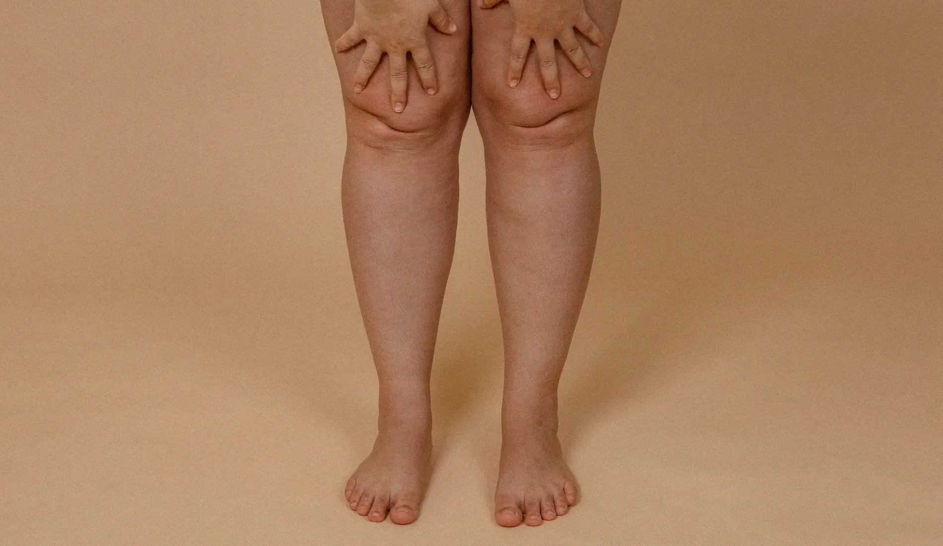 Rétention d'eau-jambes gonflées